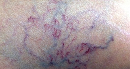4 dấu hiệu cần đi khám ngay nếu bạn không muốn bị cắt cụt chân