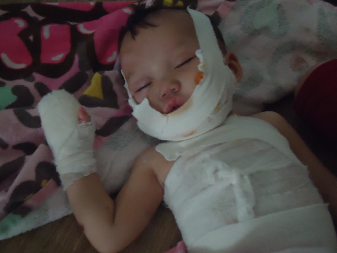 Ngã vào bếp lửa, bé trai 10 tháng tuổi nguy kịch