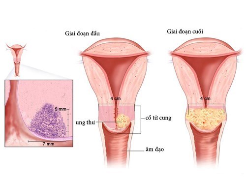 4 bước phát hiện sớm ung thư cổ tử cung