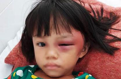 Bé gái bị mẹ kế đánh sưng mắt, châm thuốc lá bỏng tay