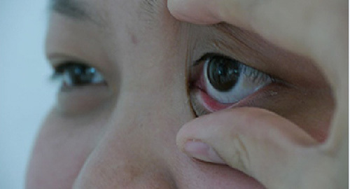 Nhận diện ‘sát thủ thầm lặng’ mang tên biến chứng tiểu đường