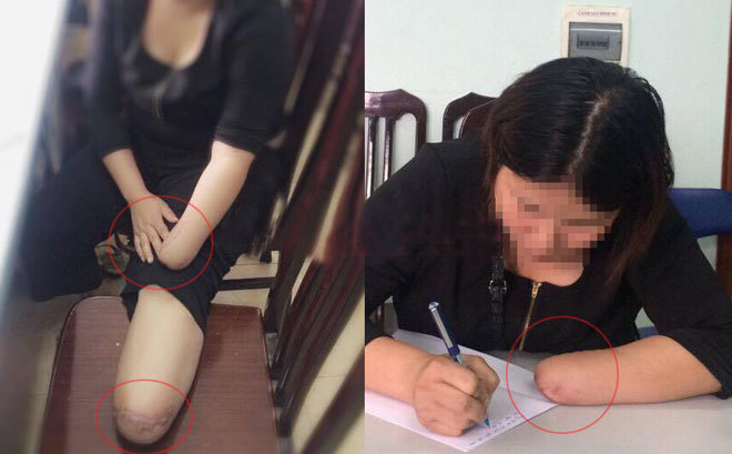Toàn cảnh vụ thuê người chặt chân tay trục lợi bảo hiểm