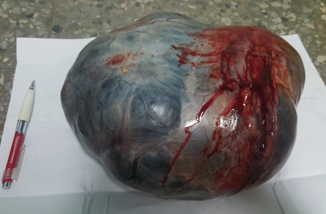 Nghĩ béo bụng, cụ bà mang khối u 4kg