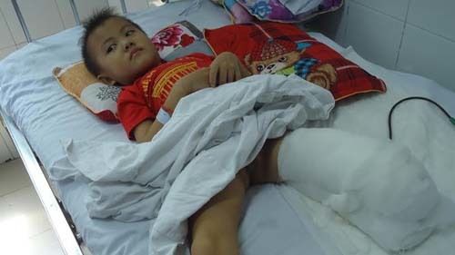 Bé 5 tuổi nguy cơ tàn tật vì cột điện đè gãy chân