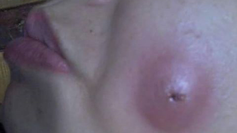 Mặt sưng vù vì làm má lúm đồng tiền giá rẻ