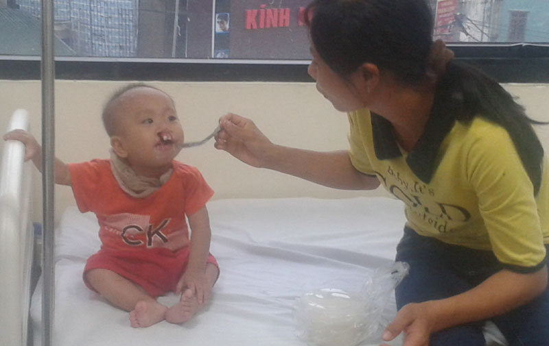 Miễn phí phẫu thuật sứt môi, hở hàm ếch cho trẻ dịp Trung Thu