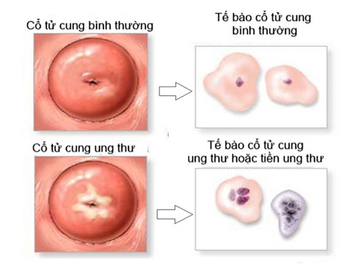 Bảo tồn trứng cho phụ nữ trẻ bị ung thư cổ tử cung