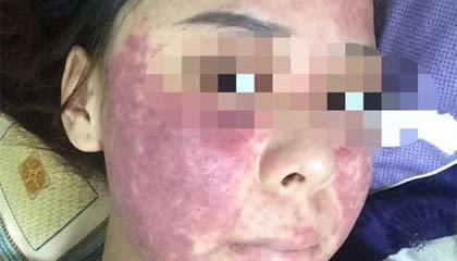 Cô gái bị lừa mua kem trị mụn không rõ nguồn gốc khiến mặt xuất huyết biến dạng
