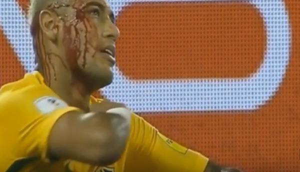 Neymar máu chảy đầm đìa