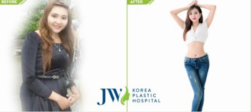 Cô lễ tân 9x giảm 10kg nhờ hút mỡ không phẫu thuật Sculpsure