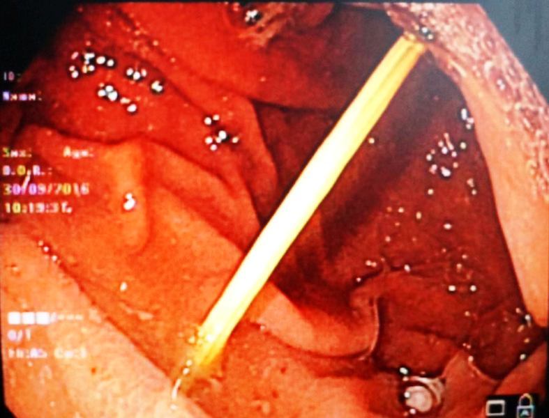 Thủng dạ dày khi nuốt tăm tre 7 cm lúc ăn sáng