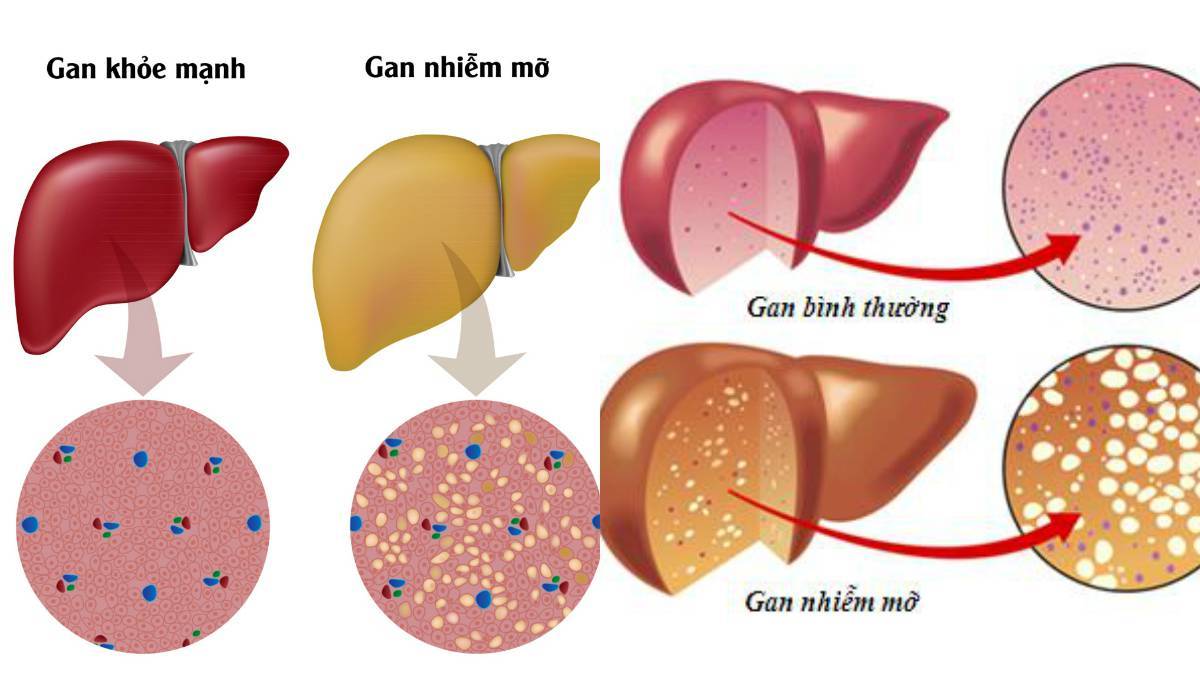 Gan nhiễm mỡ, tránh ăn gì?