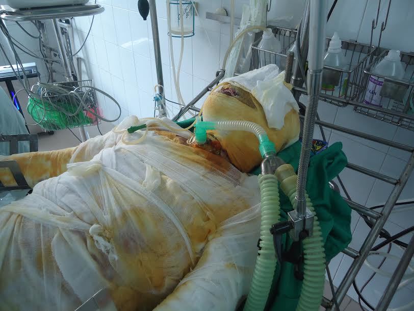 Bị bỏng xăng nặng, thanh niên nghèo giành giật sự sống từng giờ