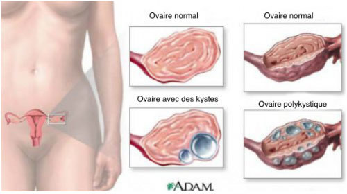 9 điều cực quan trọng về u nang buồng trứng