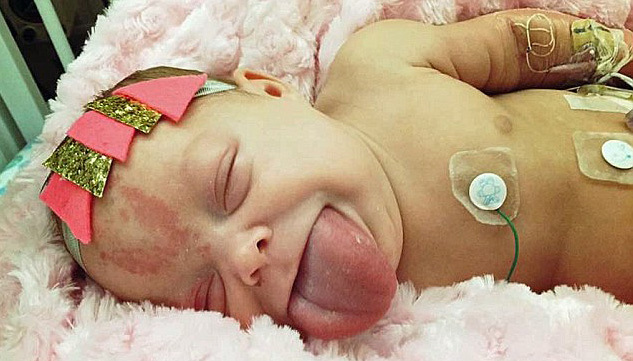 Em bé có lưỡi khổng lồ, luôn thò ra ngoài