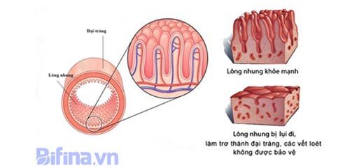 Cách hay thoát khỏi viêm đại tràng của người Nhật