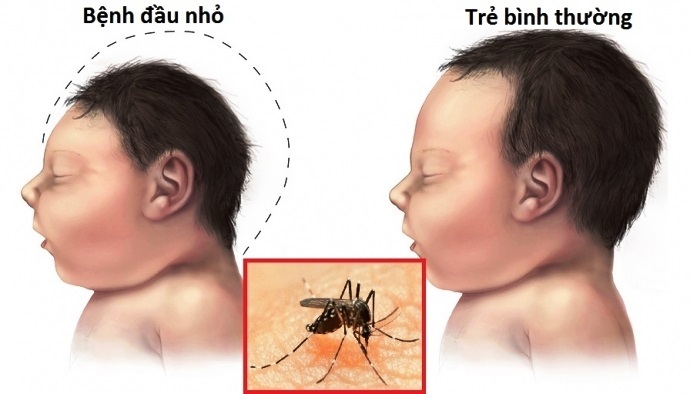 Bé 4 tuổi ở Long An nhiễm virus Zika