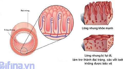 Cách hay đối phó với viêm đại tràng lâu năm