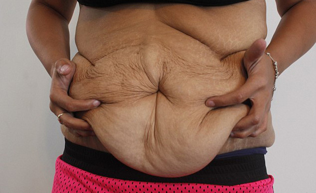 Đống da thừa xấu xí của cô gái giảm gần 60kg