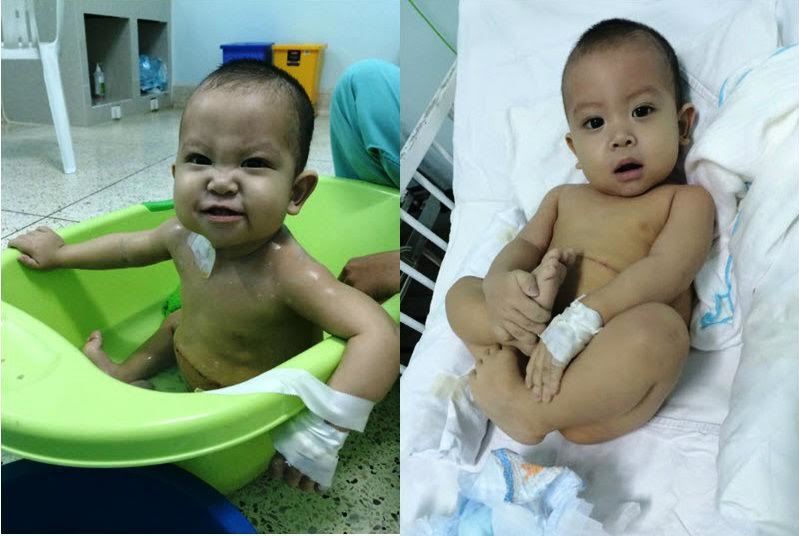 Bé trai 13 tháng tuổi được ghép gan từ bố giờ ra sao?