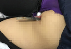 Nữ sinh 16 ngã xuống đường bị thanh sắt đâm xuyên mông