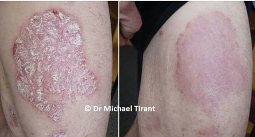 Điều trị vảy nến bằng thảo dược, không corticoid