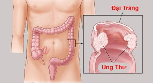 Kỹ thuật mới điều trị ung thư đại tràng