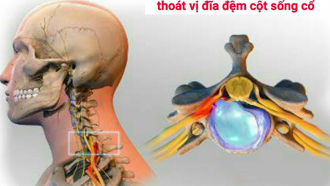 Phương pháp nào chữa thoát vị cột sống cổ?