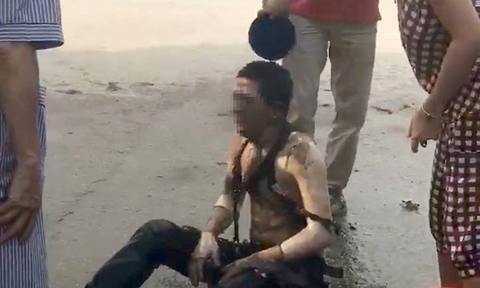 Dội nước đá cứu người bị bỏng, đúng hay sai?