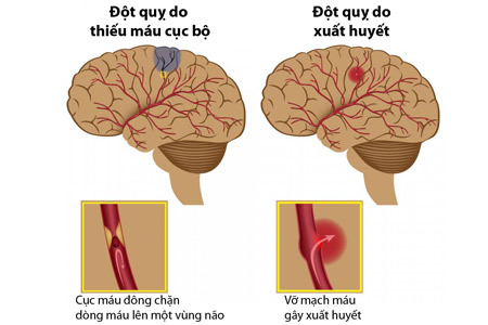 Cẩn thận trời trở lạnh dễ đột quỵ