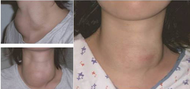 Đánh bay bướu cổ không cần phẫu thuật