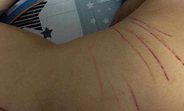 Nghi vấn cô gái trẻ bị rạch đùi trên phố Hà Nội
