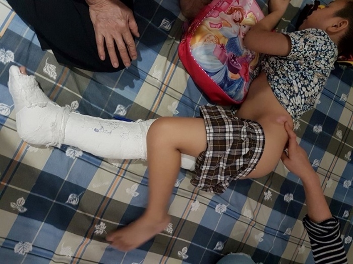 Phụ huynh nghi vấn con tự ngã gãy xương đùi trong giờ ra chơi