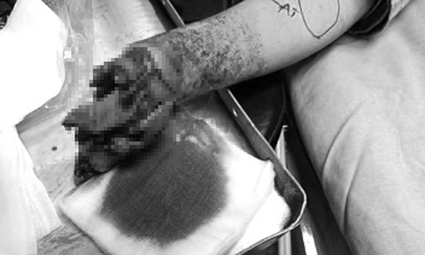 Bé trai 3 tuổi mất tay và mắt do cục sạc điện phát nổ