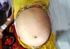 Khối u tử cung 12 kg khiến người phụ nữ như mang bầu