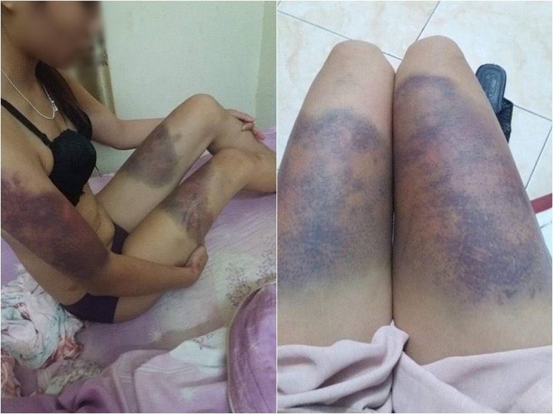 Hà Nội: Cô gái trẻ 'tố' bạn trai hành hung dã man