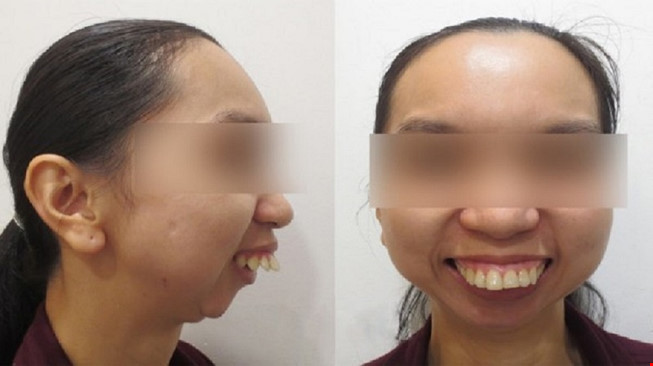 Mổ lần 46 cho cô gái nói 3 ngoại ngữ vẫn thất nghiệp