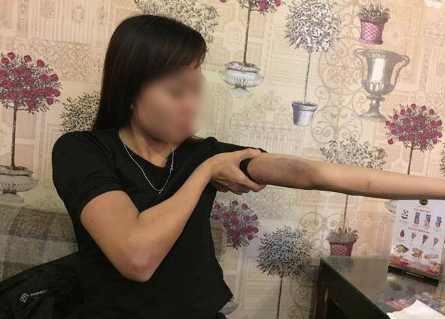 Cô gái kể về đêm bị người yêu đánh tím người