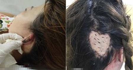 Chị em đi làm tóc cuối năm hãy cẩn thận: đã có người bị lột da đầu, người suýt mất tai