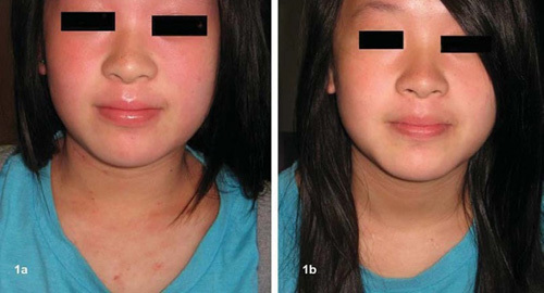 Chữa viêm da dị ứng ở trẻ bằng thảo dược