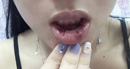 Hà Nội: Bơm môi hình trái tim, cô gái trẻ hoảng hồn khi phát hiện 18