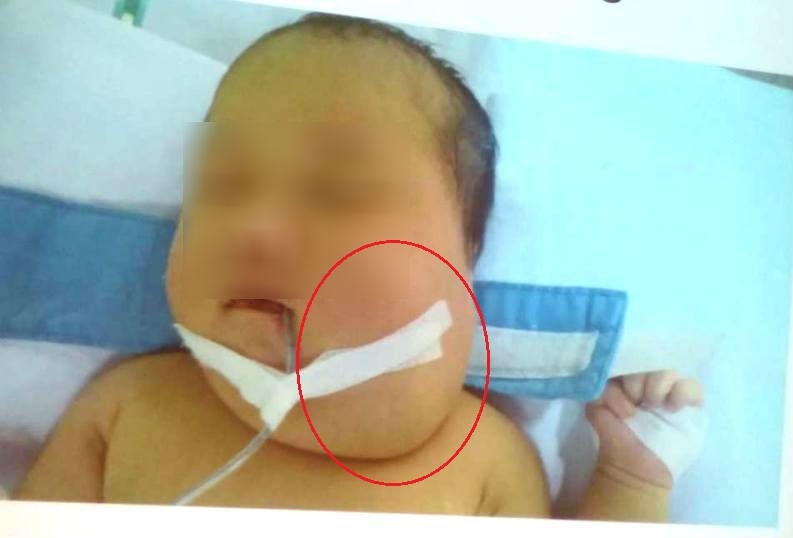 10 giờ phẫu thuật cứu bé sơ sinh mắc căn bệnh đầu tiên ở VN