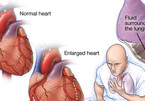 Phòng ngừa suy tim trong mùa đông