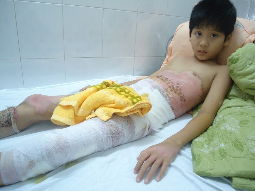 Ngã vào nồi nước phở đang sôi, bé trai nguy kịch tính mạng