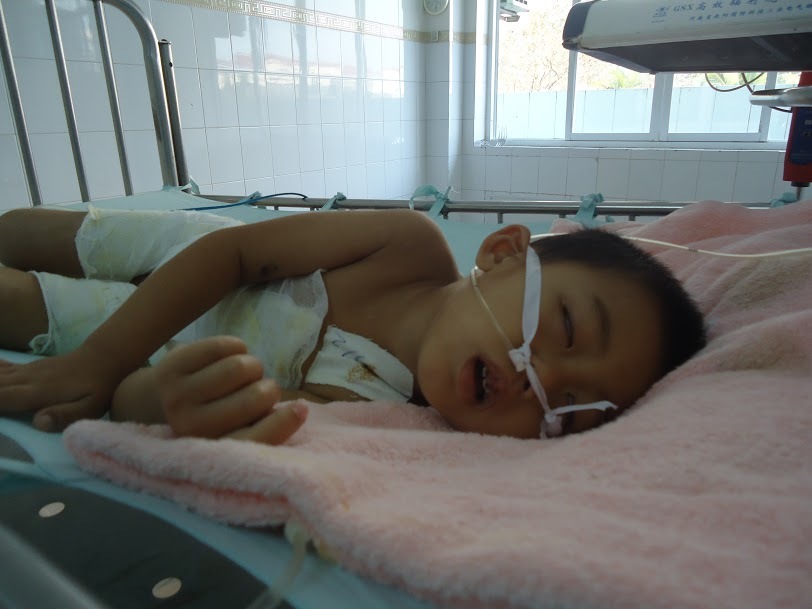 Ngã vào nồi nước luộc thịt bé trai 4 tuổi nguy kịch tính mạng