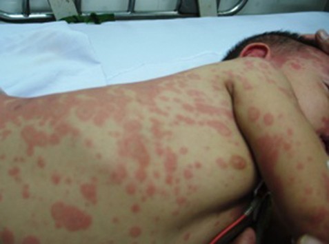 Nhiễm trùng huyết là một trong những biến chứng nghiêm trọng của bệnh não mô cầu