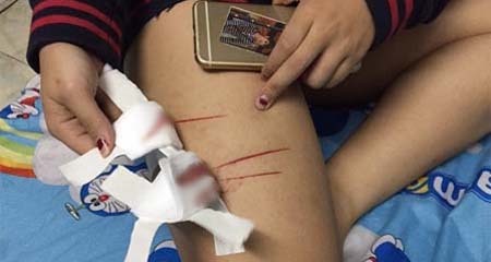 Thêm 1 cô gái trẻ ở Sài Gòn chia sẻ câu chuyện bị nhóm biến thái rạch đùi trong đêm