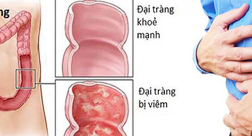 4 sai lầm khiến viêm đại tràng càng chữa càng nặng