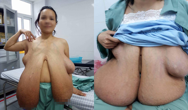 Người phụ nữ 31 tuổi mang bộ ngực khổng lồ, dài quá bẹn