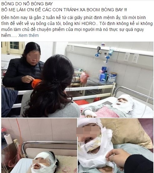 9X bị bỏng do nổ bóng bay: 'Hãy để con tránh xa loại 'bom' này
